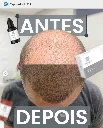 capilar3.webp